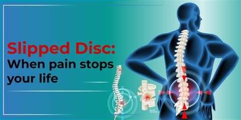 Back Pain Sufferers: Discover How Sleeping With a Slipped Disc Can Help You!